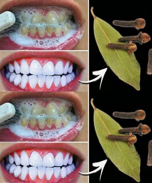 Remova o tártaro e clareie os dentes naturalmente em poucos minutos